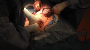 The amazing image my wife stood up just in time to capture. Oscar emerges, first loop of cord is removed from around his neck.